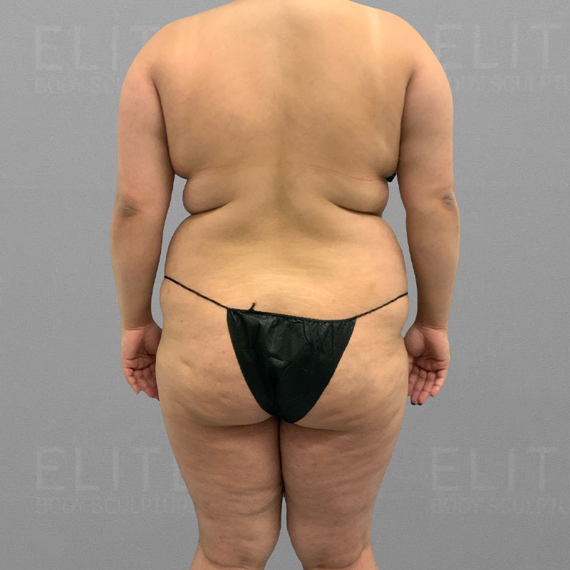 Before Full Ab, Back Bra Roll, BBL AirSculpt