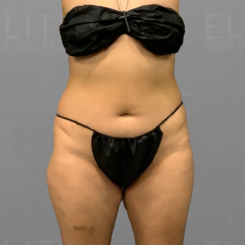 before waist airsculpt