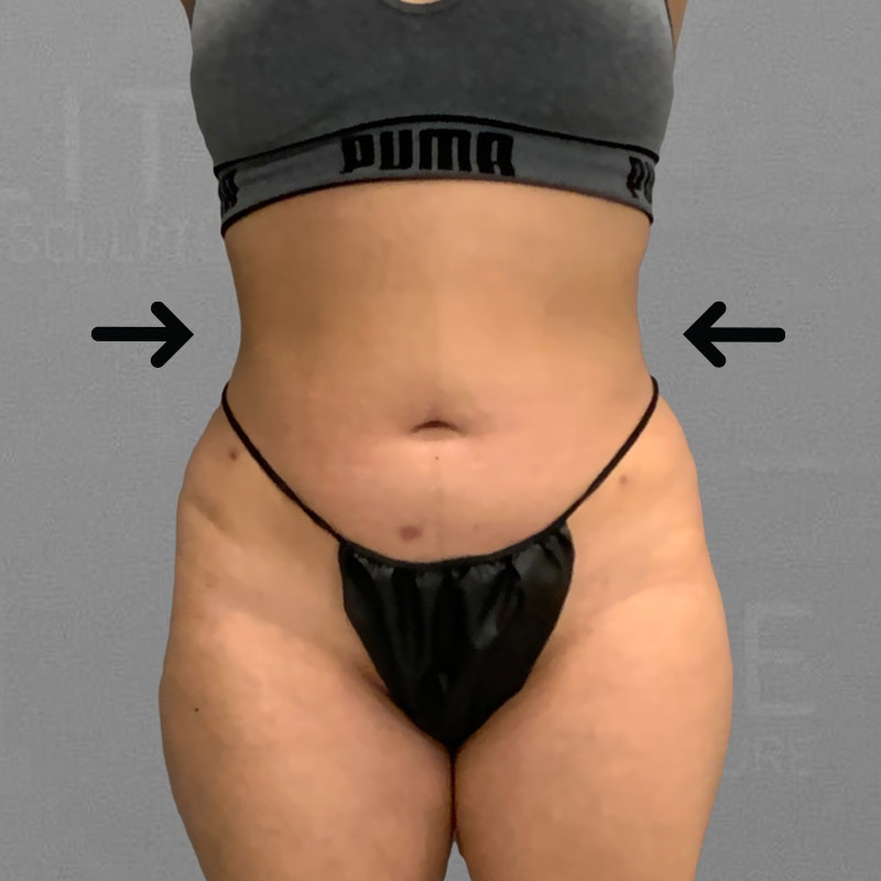 after waist airsculpt