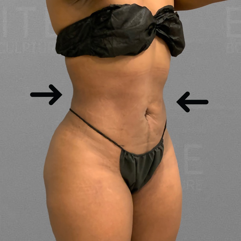 after Lower Back and Stomach AirSculpt