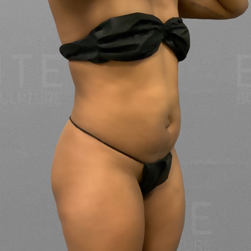 before Lower Back and Stomach AirSculpt
