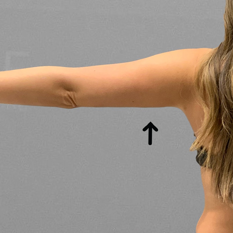 after arm airsculpt