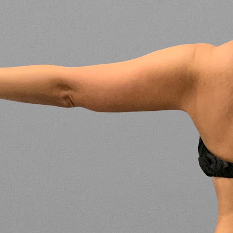 before arm airsculpt