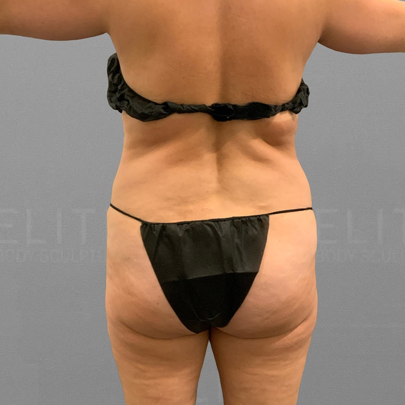 before airsculpt 