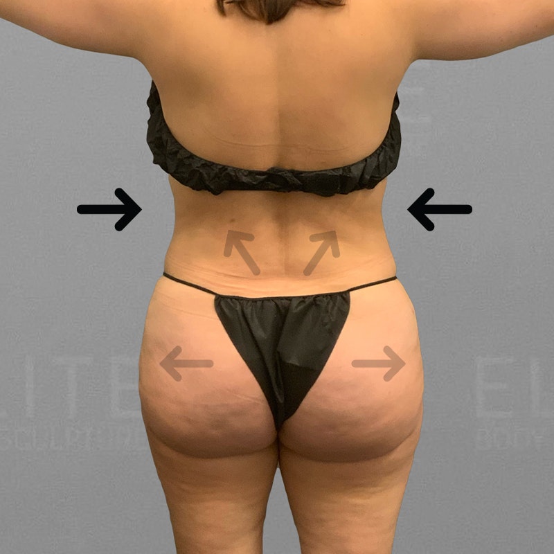 after airsculpt