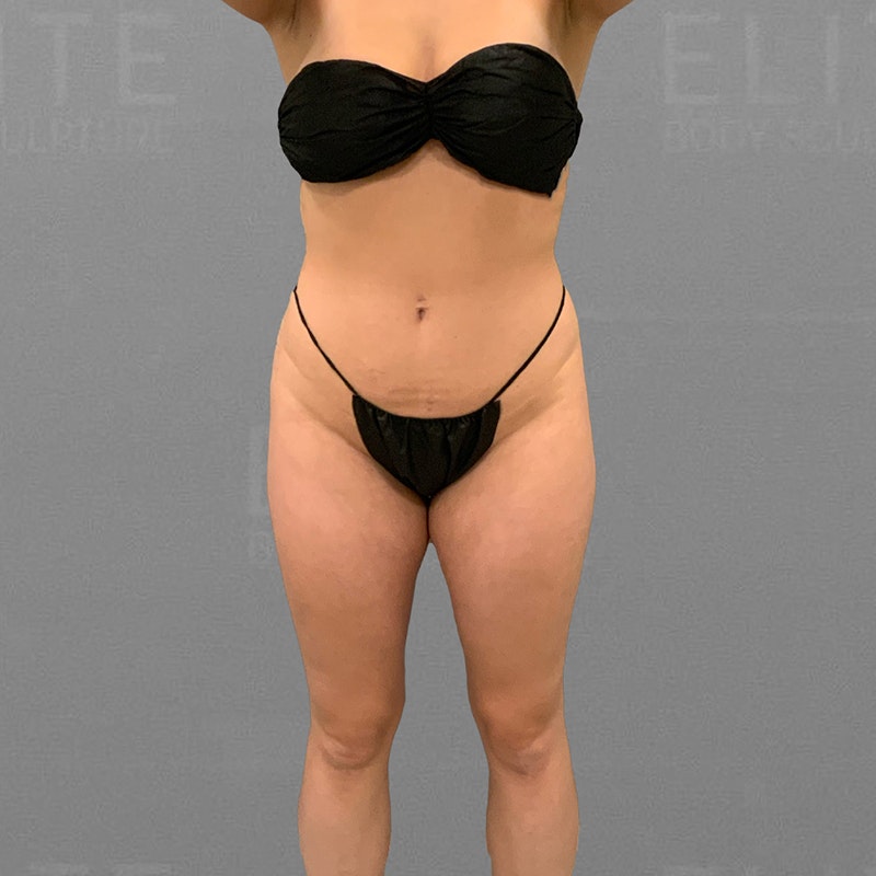before full ab and hip flip airsculpt