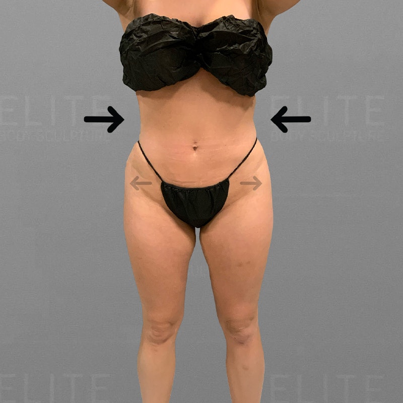 after full ab and hip flip airsculpt
