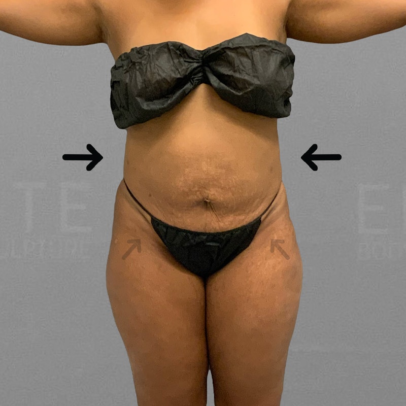 after full abdominal airsculpt