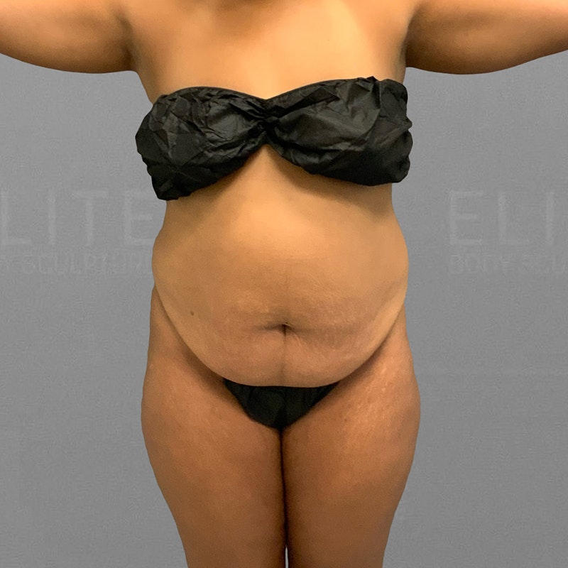 before full ab airsculpt