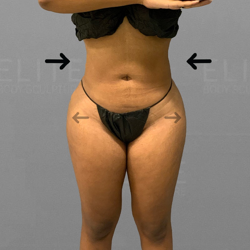 after full ab and stomach airsculpt