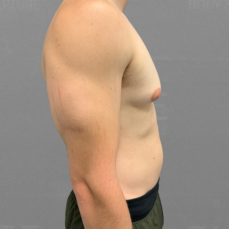 before male chest airsculpt