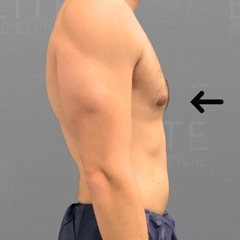 after male chest airsculpt