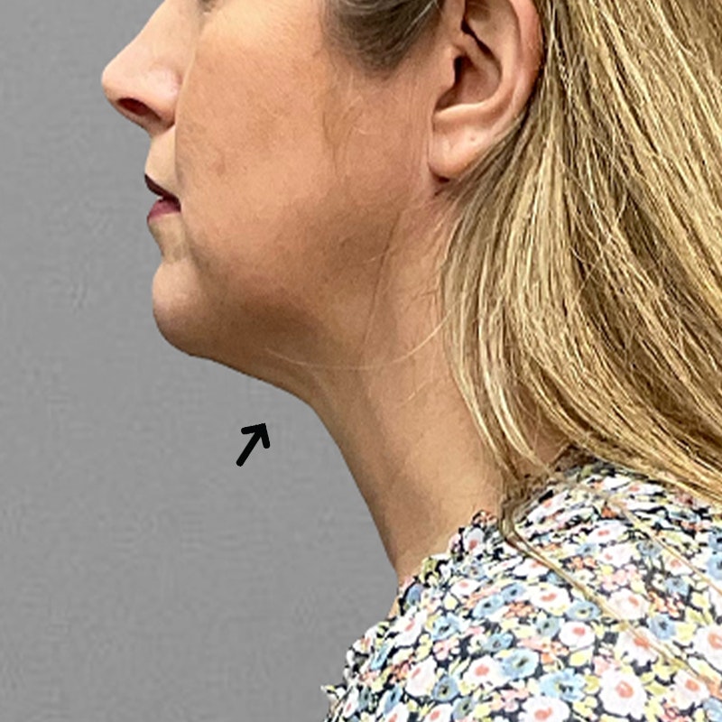 post-chin airsculpt