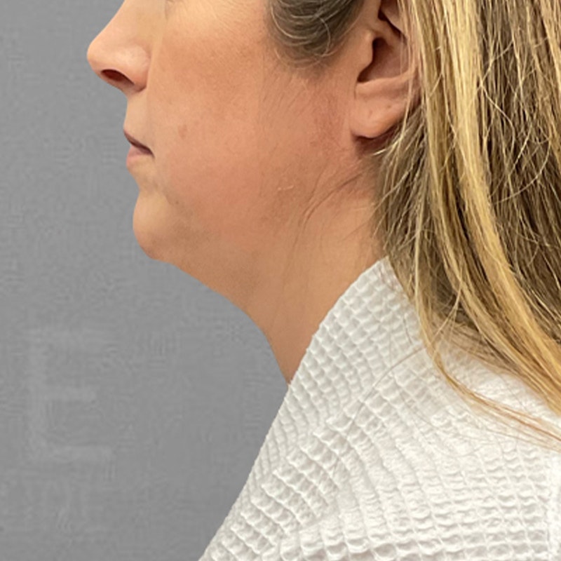pre-chin airsculpt