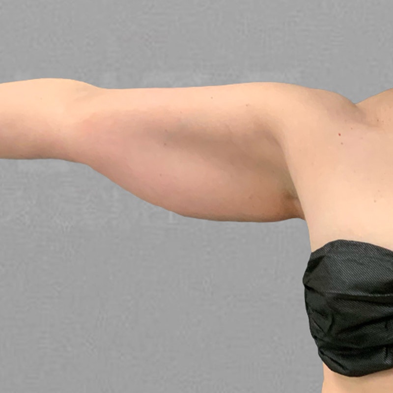 before arm liposuction