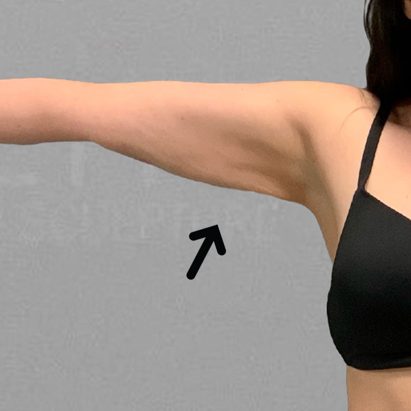 after arm liposuction