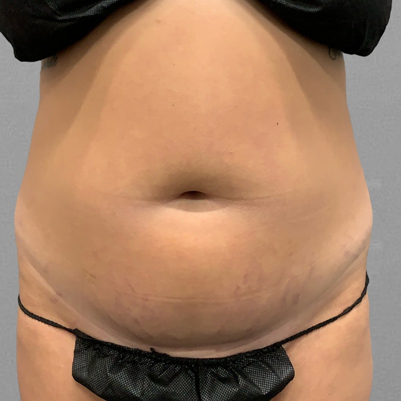 Chloe Trautman Stomach Before