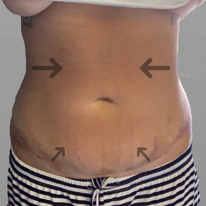 Chloe Trautman Stomach After