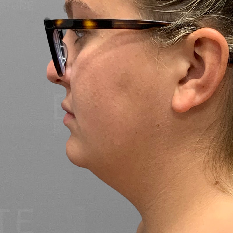 Chloe Trautman Chin Before