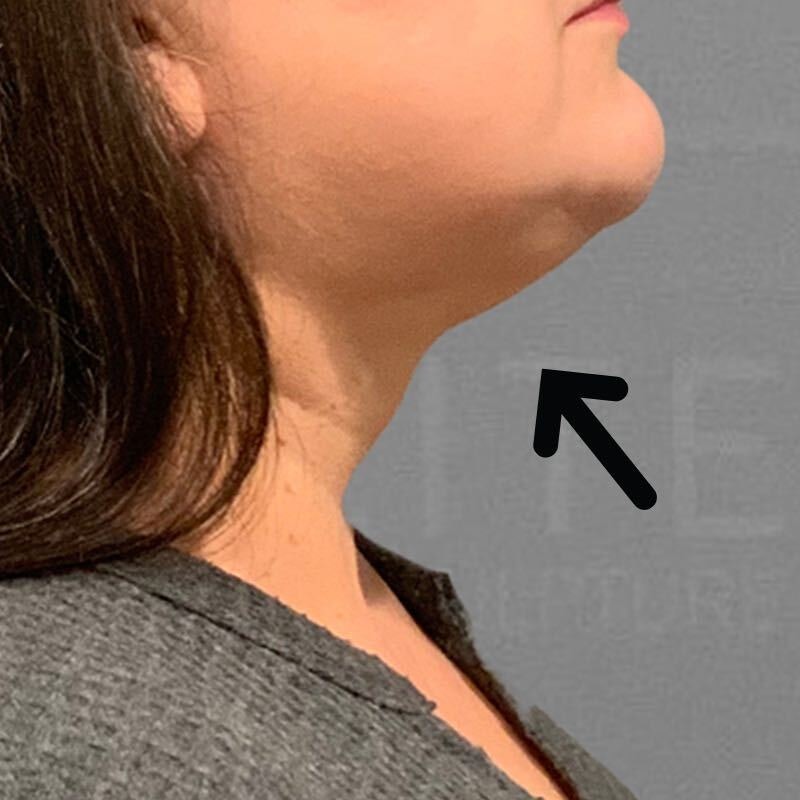 after chin liposuction