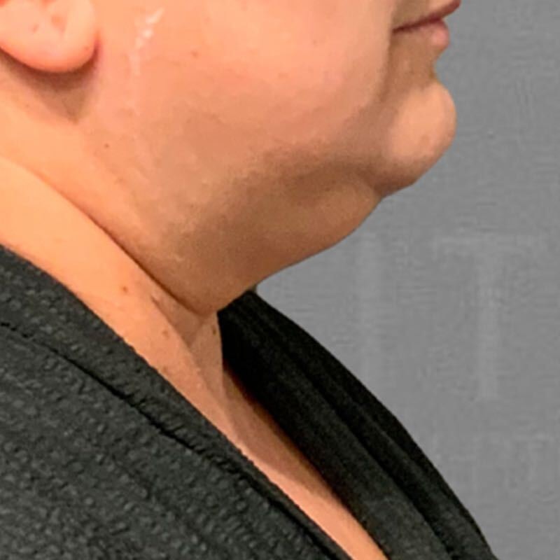 before chin liposuction