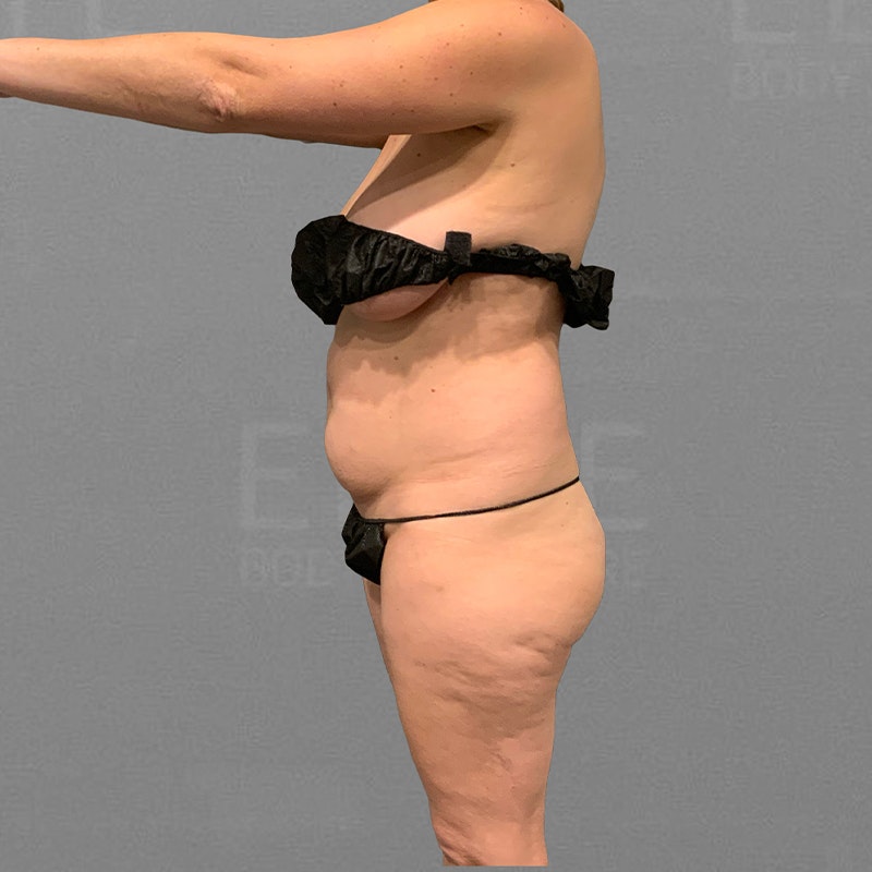 before full ab airsculpt