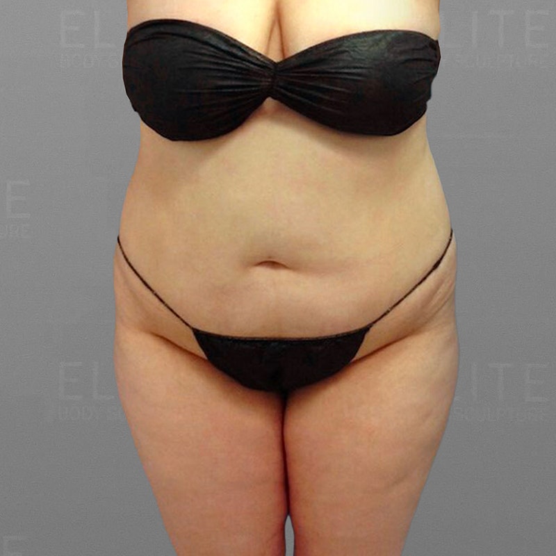 before stomach airsculpt