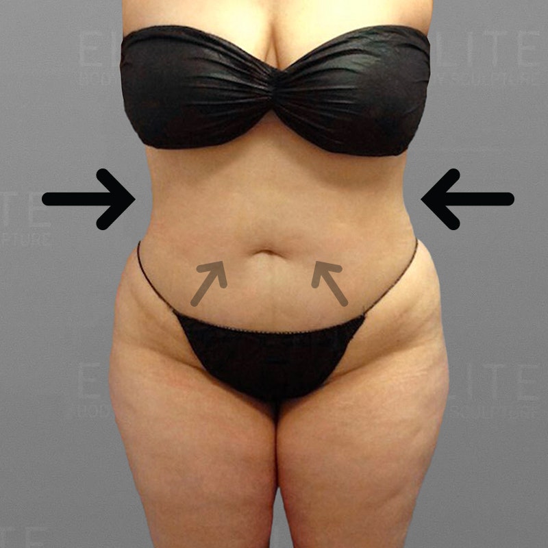 after stomach airsculpt