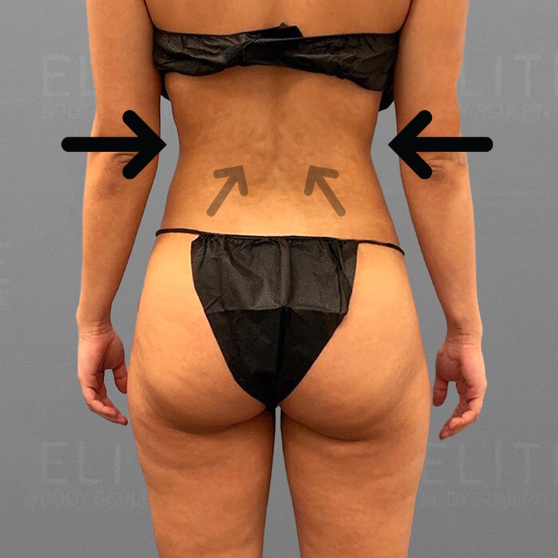 after waist and stomach airsculpt
