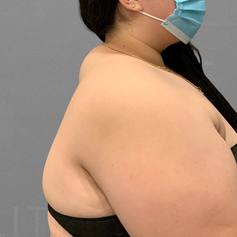 Before buffalo hump airsculpt
