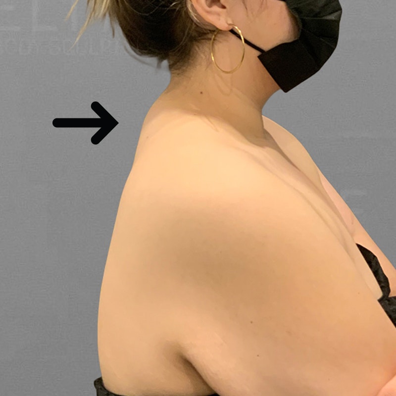 after buffalo hump airsculpt