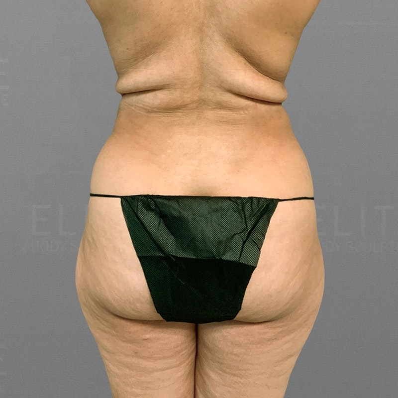 before back bra roll airsculpt