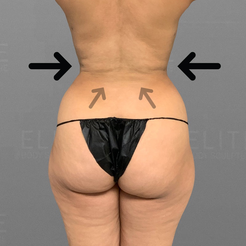 After back bra roll airsculpt