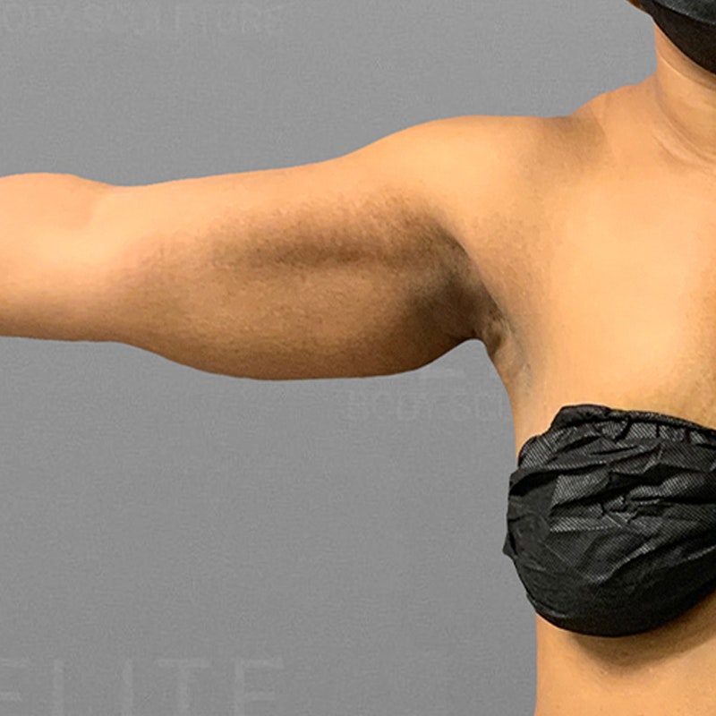 Arm AirSculpt before