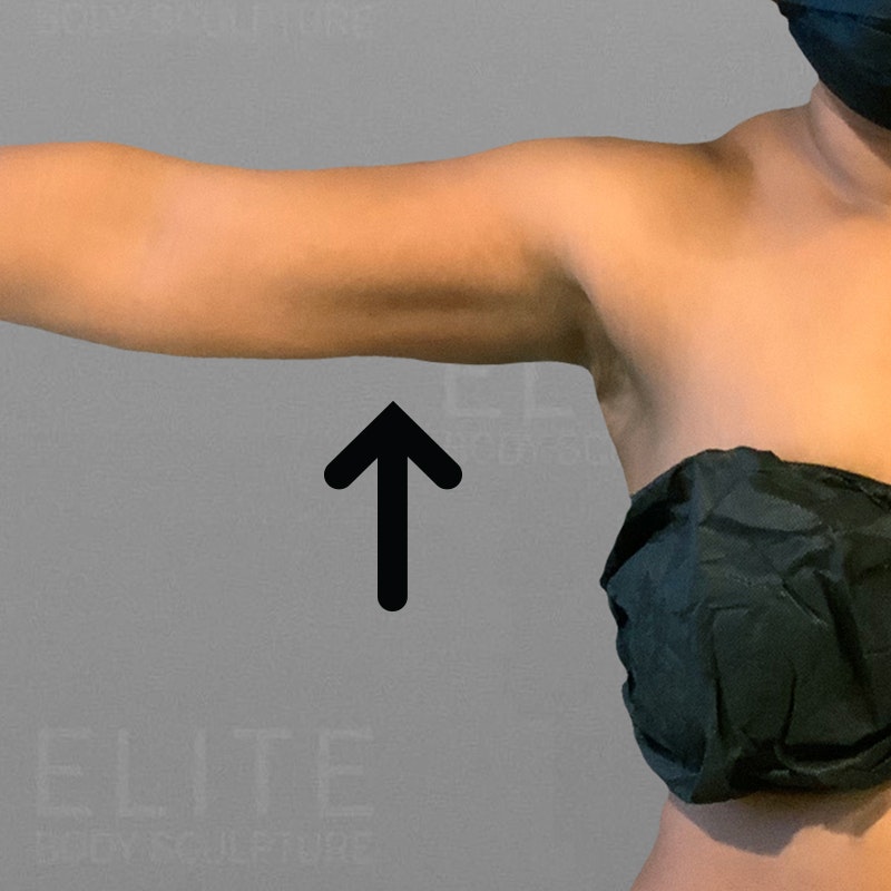 Arm AirSculpt after