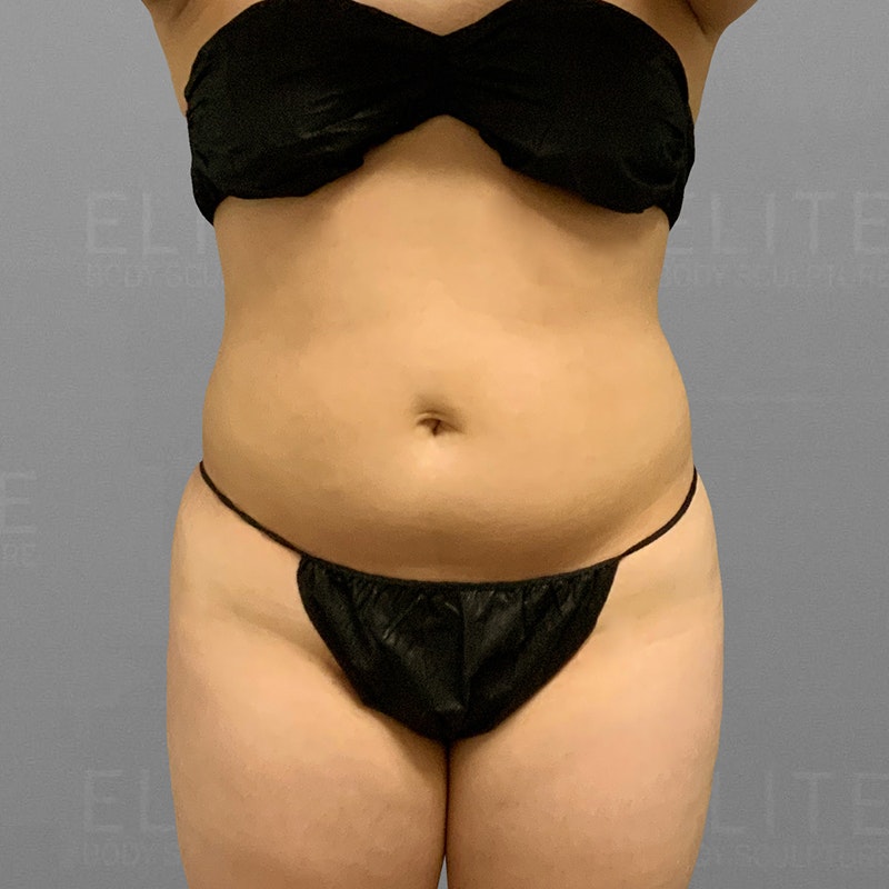 stomach airsculpt before