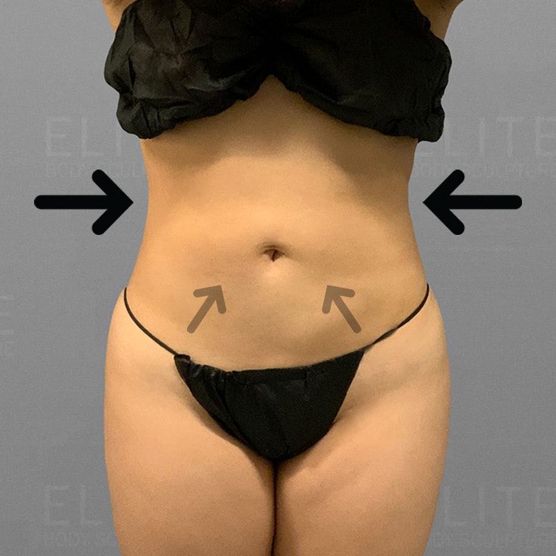 stomach airsculpt after