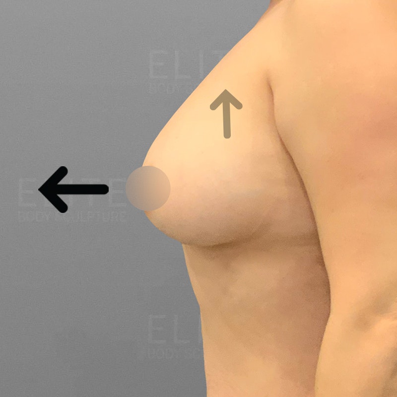 post-breast augmentation with airsculpt