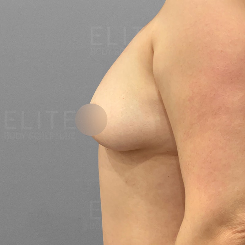pre-breast augmentation with airsculpt