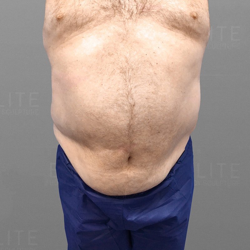 before male stomach airsculpt