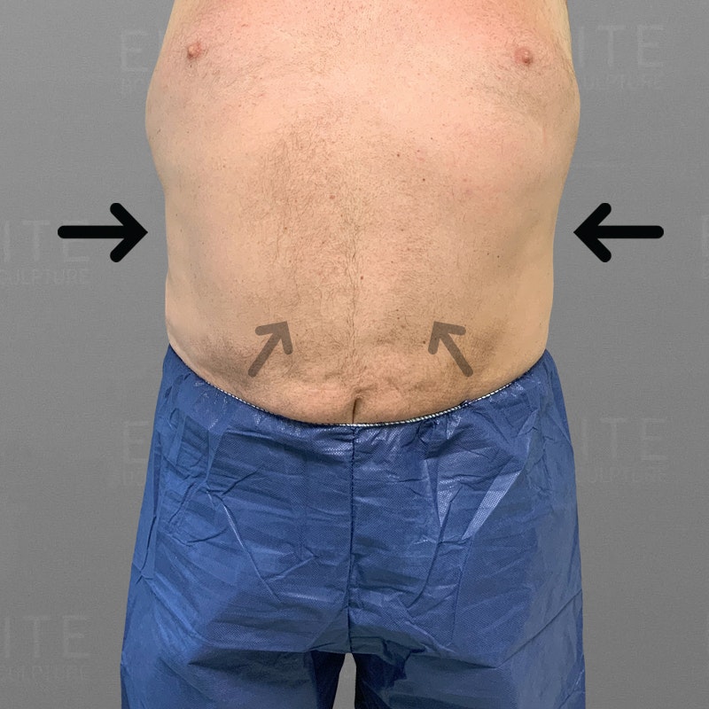 After male stomach airsculpt