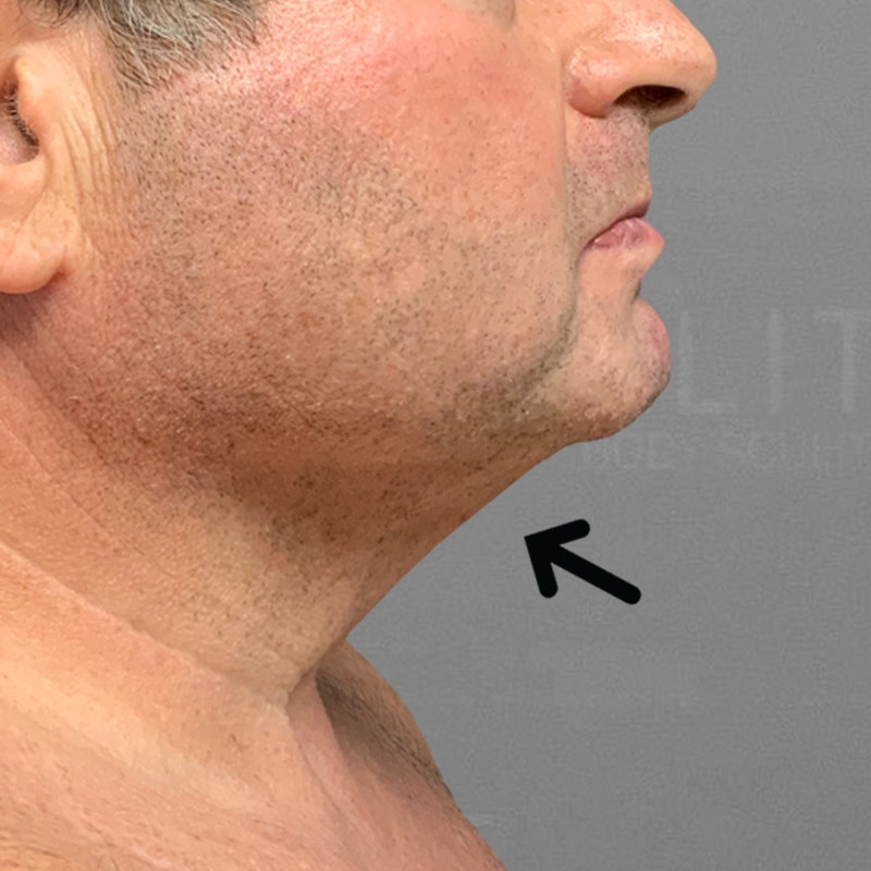 after chin airsculpt
