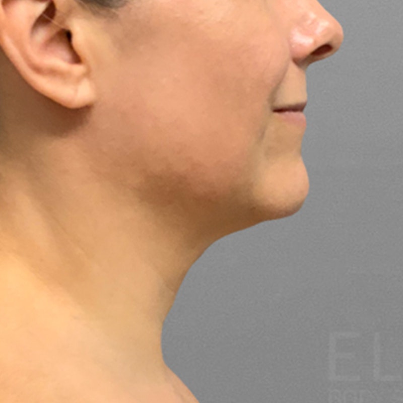 before chin airsculpt