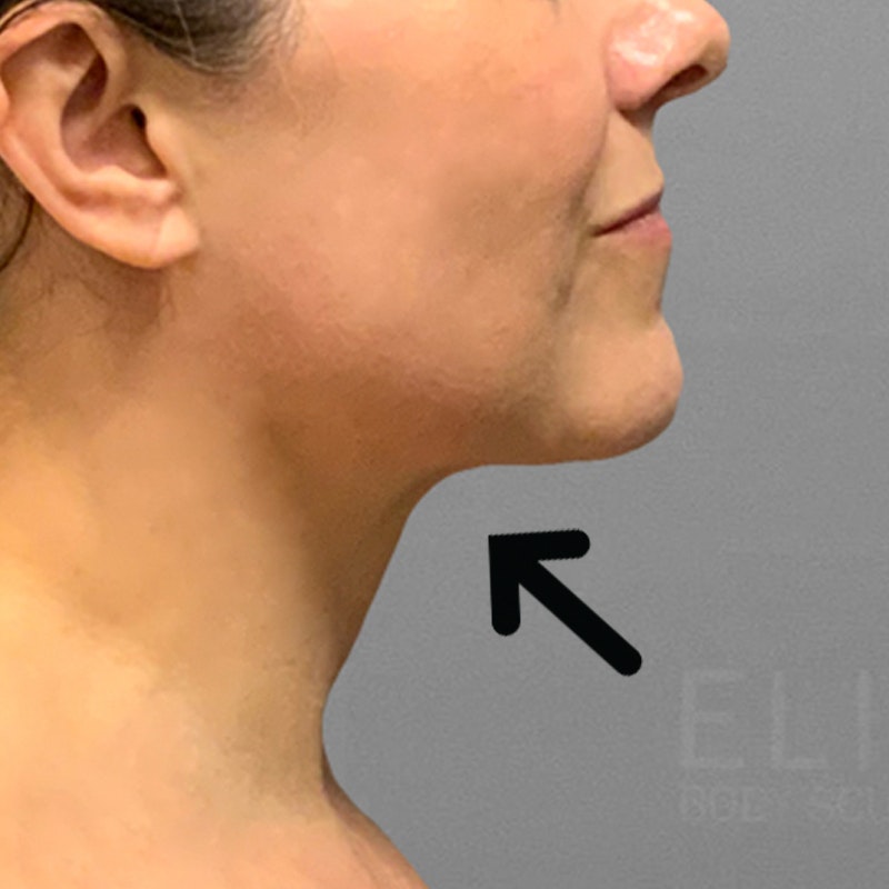 after chin airsculpt