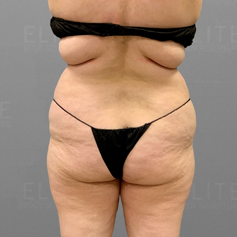before back bra roll lipo