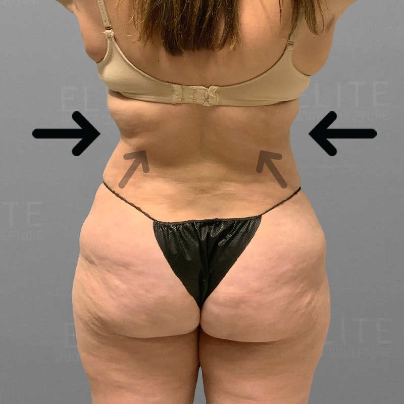 after back bra roll lipo