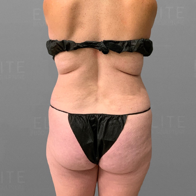 before back bra roll airsculpt