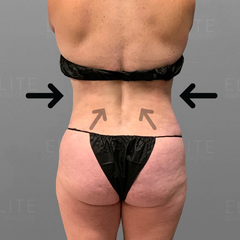 after back bra roll airsculpt