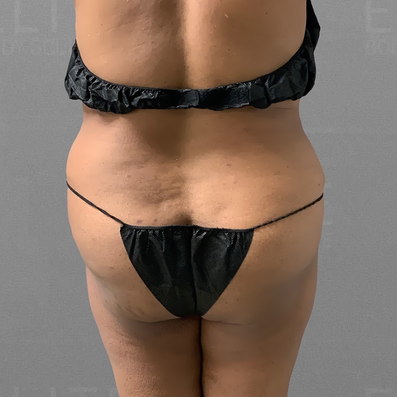 before stomach and back bra roll airsculpt