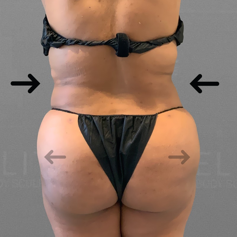 after stomach and back bra roll airsculpt